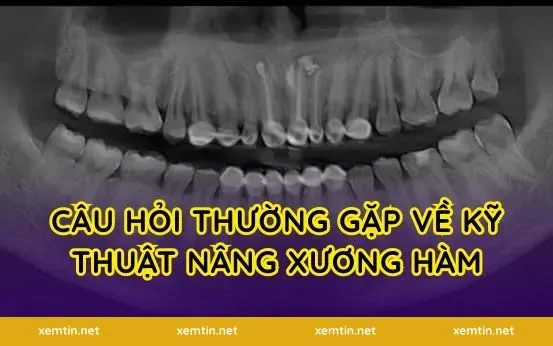 Câu hỏi thường gặp về kỹ thuật nâng xương hàm