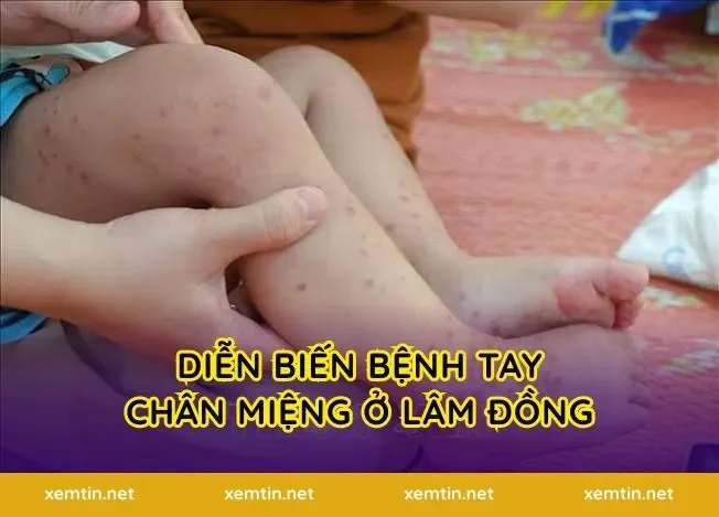 Diễn Biến Bệnh Tay Chân Miệng Ở Lâm Đồng