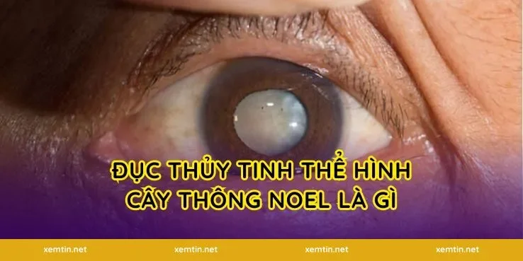 Đục thủy tinh thể hình cây thông Noel là gì