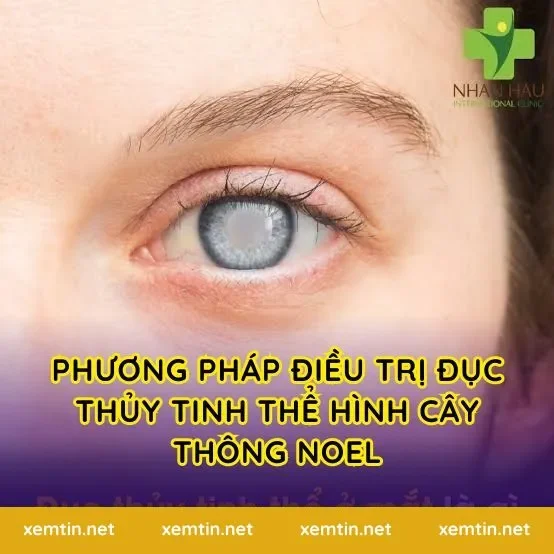 Phương pháp điều trị đục thủy tinh thể hình cây thông Noel