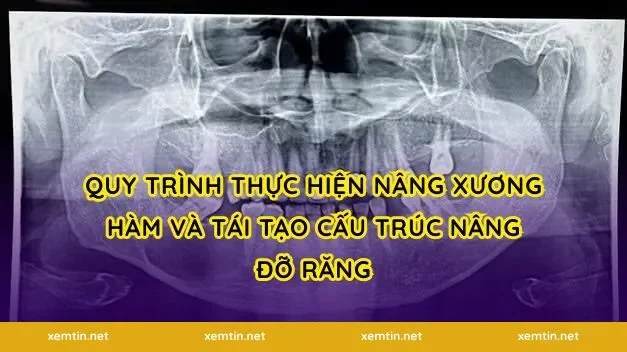 Quy trình thực hiện nâng xương hàm và tái tạo cấu trúc nâng đỡ răng