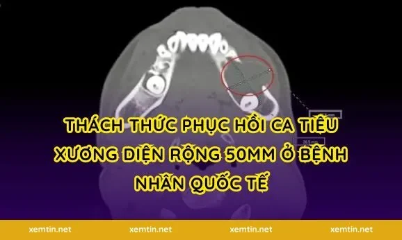Thách thức phục hồi ca tiêu xương diện rộng 50mm ở bệnh nhân quốc tế