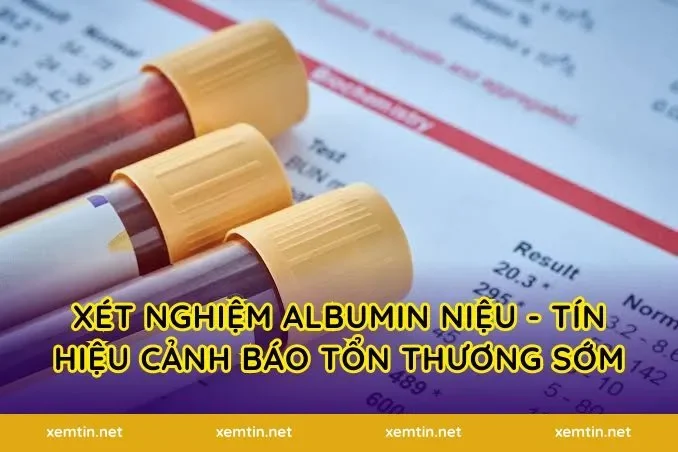 Xét nghiệm albumin niệu - Tín hiệu cảnh báo tổn thương sớm