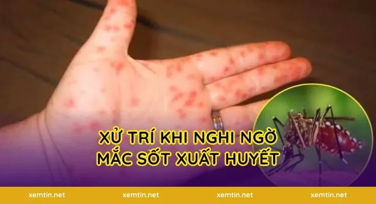 Xử Trí Khi Nghi Ngờ Mắc Sốt Xuất Huyết